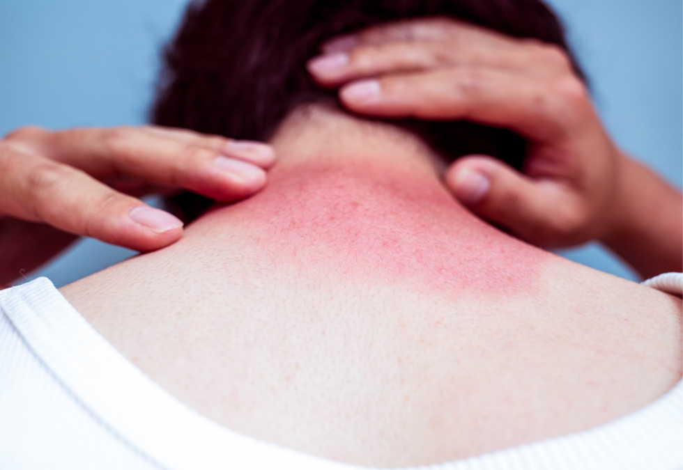 How Do Sunburns Affect Massage Therapy?